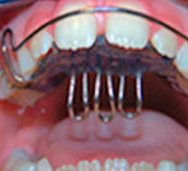 Ortodoncia removible